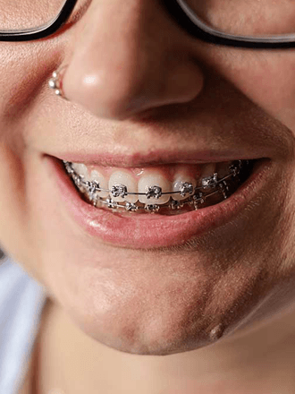 What are the different types of braces?