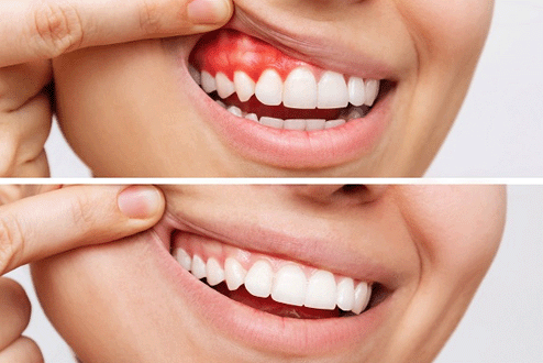 ابتسامة أجمل… هل أختار علاج اللثة التقليدي أم بوتوكس الابتسامة اللثوية؟