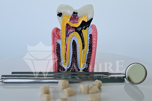 Tooth Extraction vs. Root Canal: Which Option Is Better for You?