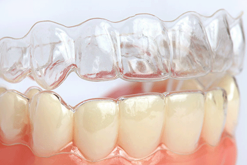 Invisalign Braces: The Detailed Guide to Clear Aligners at Saphire Dent Clinic