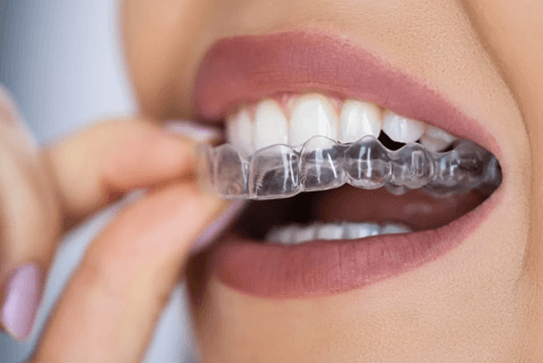 تقويم إنفزلاين الشفاف: ابتسامة طبيعية بتقنية رقمية متطورة