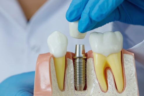Dental Implants: Advanced Care for Missing Teeth
