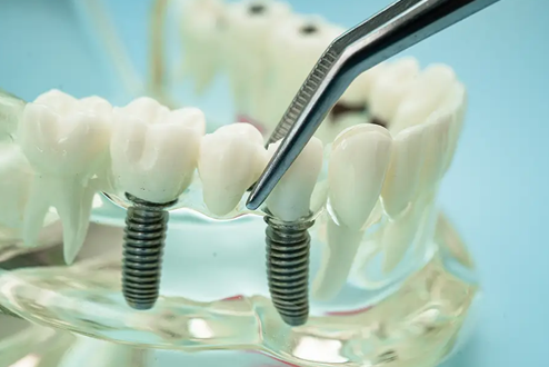 Thinking About Dental Implants? Here’s What Most Patients Want to Know First