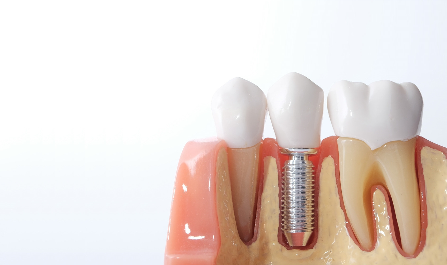 Implantology (Dental Implants)