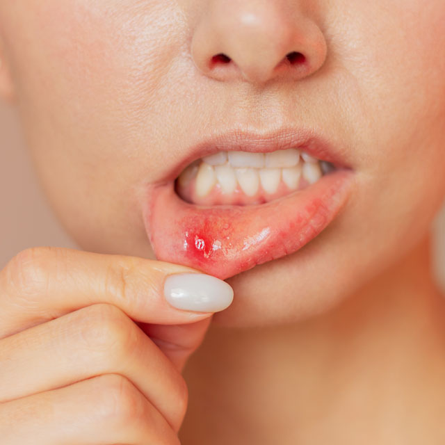 Aphthous Ulcer & Herpes Treatment