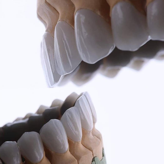 Dental Bridges