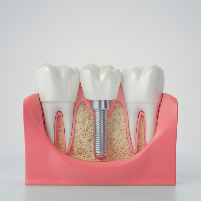 Single Tooth Implant